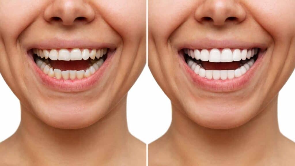 Contact Aspire White for teeth whitening services – Get in touch with Eastbourne today