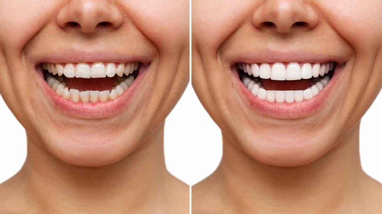 Contact Aspire White for teeth whitening services – Get in touch with Eastbourne today