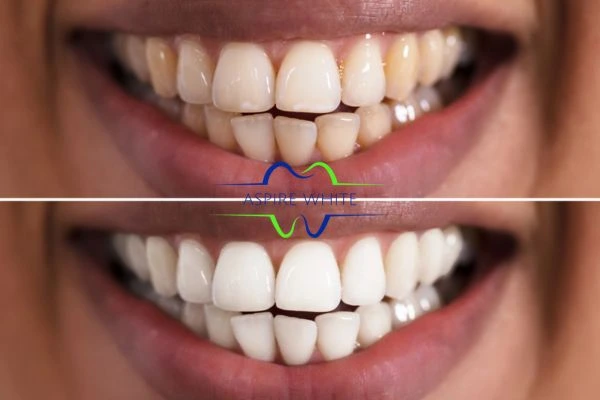 Aspire White customer before and after Eastbourne results.