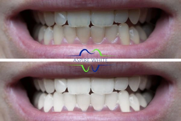 1 hour laser teeth whitening before and after results Eastbourne