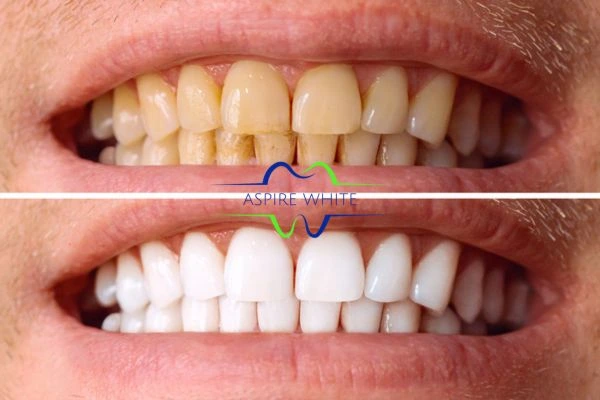 Get noticeable whiter smile in just one hour! Book your teeth whitening treatment Eastbourne today!