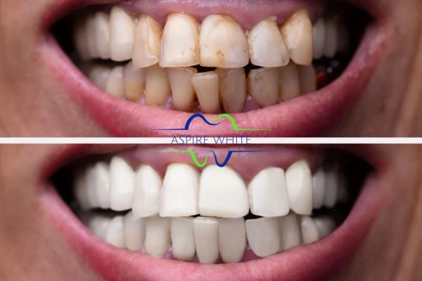 Before and after results of laser teeth whitening Eastbourne Book in online today!