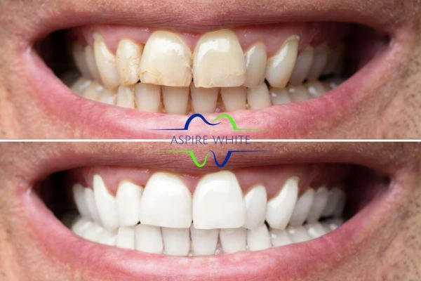 Achieve a radiant smile with professional laser teeth whitening Eastbourne